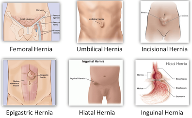 What causes abdominal hernias in paeds and adults?